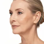 Deep Plane Facelift - 10 Years Younger