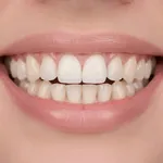 Straumann Dental Implant – Swiss Quality