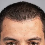 FUE Hair Transplant Turkey – All Inclusive