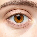 Keratopigmentation - Permanent Eye Color Change