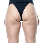 Inner Thigh Lift Surgery - Medial Thighplasty