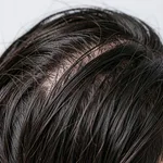 PRP Hair Restoration Therapy - 3 Sessions