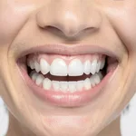 Full Mouth Zirconia Crowns - 28 Teeth