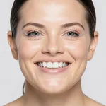 E-Max Veneers - Full Smile Design 20 Teeth