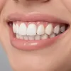 Dental Veneers