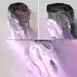 Sapphire FUE Hair Transplant – 5000 Grafts